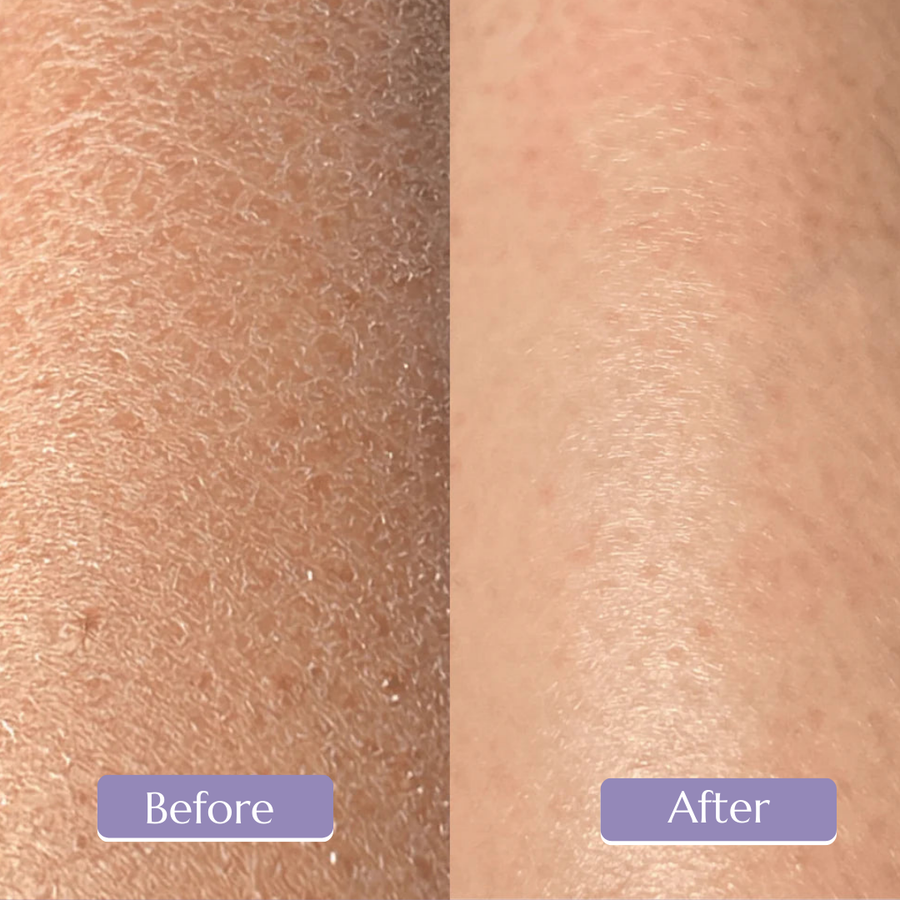 Smooth & Clear — Exfoliating Ingrown Hair Removal Glove  🧤